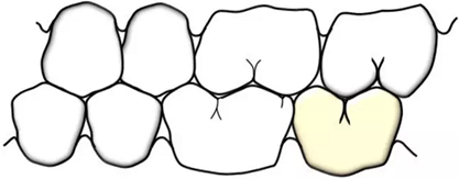 咬合記錄的對(duì)與錯(cuò) 咬合記錄的對(duì)與錯(cuò)