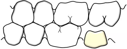 咬合記錄的對(duì)與錯(cuò) 咬合記錄的對(duì)與錯(cuò)