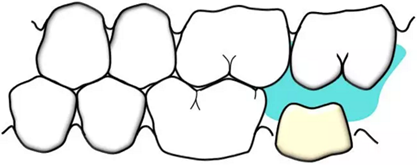 咬合記錄的對(duì)與錯(cuò) 咬合記錄的對(duì)與錯(cuò)