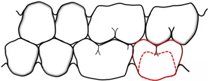咬合記錄的對(duì)與錯(cuò) 咬合記錄的對(duì)與錯(cuò)