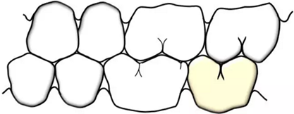 咬合記錄的對(duì)與錯(cuò) 咬合記錄的對(duì)與錯(cuò)