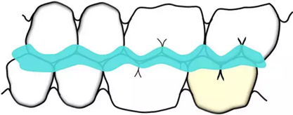 咬合記錄的對(duì)與錯(cuò) 咬合記錄的對(duì)與錯(cuò)