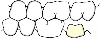 咬合記錄的對(duì)與錯(cuò) 咬合記錄的對(duì)與錯(cuò)