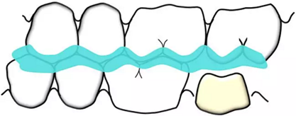 咬合記錄的對(duì)與錯(cuò) 咬合記錄的對(duì)與錯(cuò)