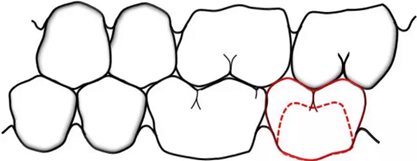 咬合記錄的對(duì)與錯(cuò) 咬合記錄的對(duì)與錯(cuò)