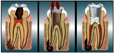 根管治療時四種殘髓處理方法 根管治療時四種殘髓處理方法