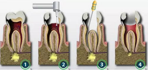 根管治療常見的難點與解決方案 根管治療常見的難點與解決方案