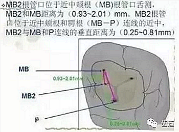 根管治療常見的難點與解決方案 根管治療常見的難點與解決方案