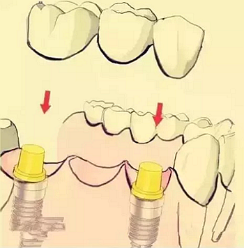 【牙齒種植】健康牙齒&ldquo;種&rdquo;出來