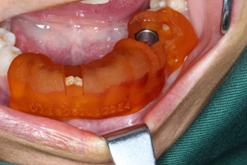 【病例分享】Implant Guide?數(shù)字化全程導(dǎo)航及椅旁即刻修復(fù)一例 【病例分享】Implant Guide?數(shù)字化全程導(dǎo)航及椅旁即刻修復(fù)一例
