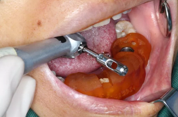 【病例分享】Implant Guide?數(shù)字化全程導(dǎo)航及椅旁即刻修復(fù)一例 【病例分享】Implant Guide?數(shù)字化全程導(dǎo)航及椅旁即刻修復(fù)一例