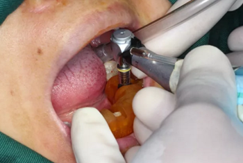 【病例分享】Implant Guide?數(shù)字化全程導(dǎo)航及椅旁即刻修復(fù)一例 【病例分享】Implant Guide?數(shù)字化全程導(dǎo)航及椅旁即刻修復(fù)一例