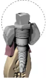 【病例分享】Implant Guide?數(shù)字化全程導(dǎo)航及椅旁即刻修復(fù)一例 【病例分享】Implant Guide?數(shù)字化全程導(dǎo)航及椅旁即刻修復(fù)一例