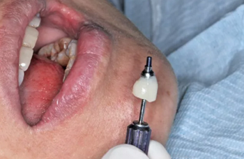 【病例分享】Implant Guide?數(shù)字化全程導(dǎo)航及椅旁即刻修復(fù)一例 【病例分享】Implant Guide?數(shù)字化全程導(dǎo)航及椅旁即刻修復(fù)一例