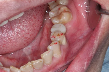 【病例分享】Implant Guide?數(shù)字化全程導(dǎo)航及椅旁即刻修復(fù)一例 【病例分享】Implant Guide?數(shù)字化全程導(dǎo)航及椅旁即刻修復(fù)一例