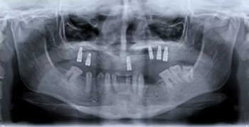 病例討論:釉質(zhì)發(fā)育不全 1 例 病例討論:釉質(zhì)發(fā)育不全 1 例
