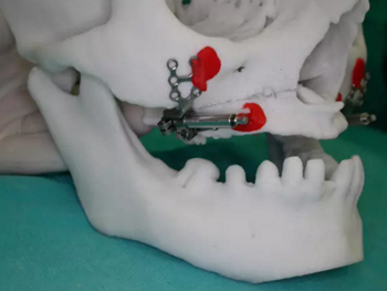 病例討論:釉質(zhì)發(fā)育不全 1 例 病例討論:釉質(zhì)發(fā)育不全 1 例