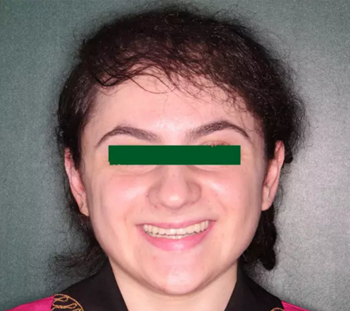 病例討論:釉質(zhì)發(fā)育不全 1 例 病例討論:釉質(zhì)發(fā)育不全 1 例