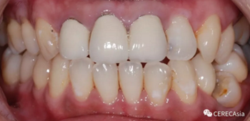 臨床案例分享-拆除原有金瓷冠，恢復(fù)病人美觀自信