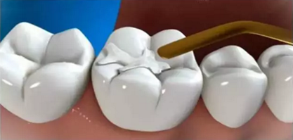 【科普】牙齒根管治療大全 【科普】牙齒根管治療大全