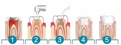 【科普】牙齒根管治療大全 【科普】牙齒根管治療大全