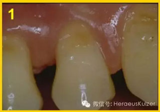 簡單治療——格魯瑪脫敏劑的應用 簡單治療——格魯瑪脫敏劑的應用