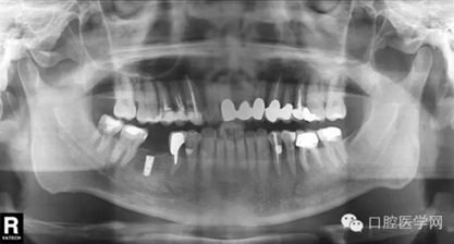 如何在X光片上判斷種植體的品牌 如何在X光片上判斷種植體的品牌