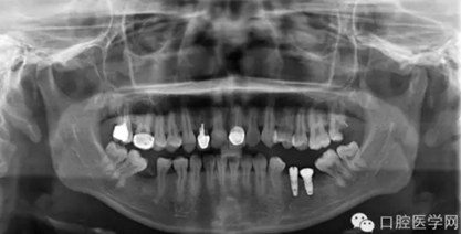 如何在X光片上判斷種植體的品牌 如何在X光片上判斷種植體的品牌