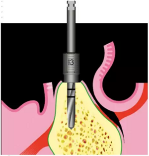 Camlog種植體外科種植小技巧 Camlog種植體外科種植小技巧