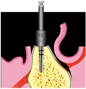 Camlog種植體外科種植小技巧 Camlog種植體外科種植小技巧
