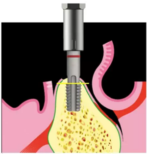 Camlog種植體外科種植小技巧 Camlog種植體外科種植小技巧