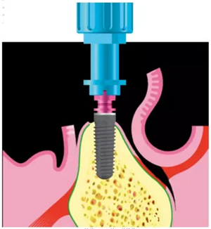 Camlog種植體外科種植小技巧 Camlog種植體外科種植小技巧