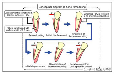 正畸文獻(xiàn)閱讀--對(duì)于滑動(dòng)法關(guān)閉間隙的有限元分析 正畸文獻(xiàn)閱讀--對(duì)于滑動(dòng)法關(guān)閉間隙的有限元分析