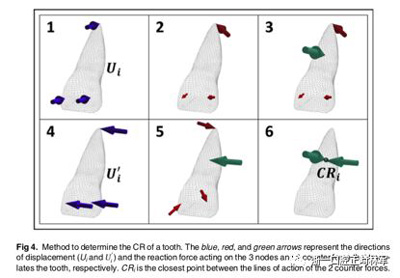 正畸文獻(xiàn)閱讀--對(duì)于滑動(dòng)法關(guān)閉間隙的有限元分析 正畸文獻(xiàn)閱讀--對(duì)于滑動(dòng)法關(guān)閉間隙的有限元分析