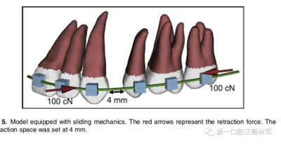 正畸文獻(xiàn)閱讀--對(duì)于滑動(dòng)法關(guān)閉間隙的有限元分析 正畸文獻(xiàn)閱讀--對(duì)于滑動(dòng)法關(guān)閉間隙的有限元分析