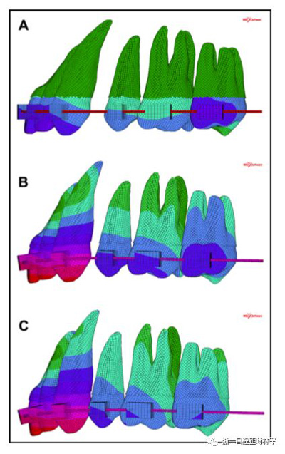 正畸文獻(xiàn)閱讀--對(duì)于滑動(dòng)法關(guān)閉間隙的有限元分析 正畸文獻(xiàn)閱讀--對(duì)于滑動(dòng)法關(guān)閉間隙的有限元分析
