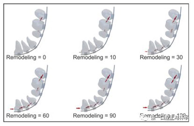 正畸文獻(xiàn)閱讀--對(duì)于滑動(dòng)法關(guān)閉間隙的有限元分析 正畸文獻(xiàn)閱讀--對(duì)于滑動(dòng)法關(guān)閉間隙的有限元分析