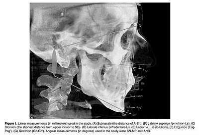 正畸文獻(xiàn)閱讀--使用CBCT評(píng)估具有不同垂直生長模式的成人患者的面下1/3的軟組織厚度值 正畸文獻(xiàn)閱讀--使用CBCT評(píng)估具有不同垂直生長模式的成人患者的面下1/3的軟組織厚度值