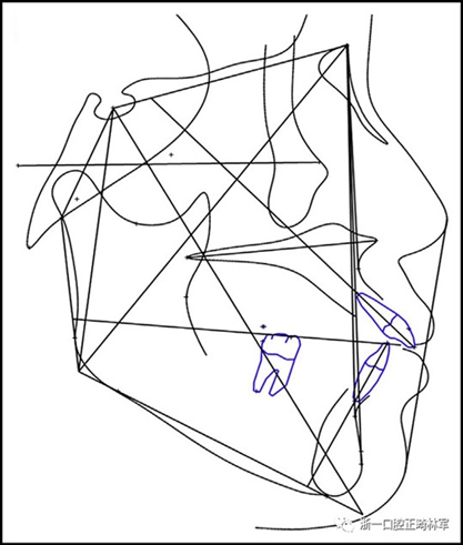 文獻優(yōu)秀正畸病例賞析--多顆牙齒缺失的牙周炎患者的跨學(xué)科綜合治療 文獻優(yōu)秀正畸病例賞析--多顆牙齒缺失的牙周炎患者的跨學(xué)科綜合治療
