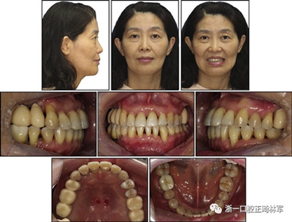 文獻優(yōu)秀正畸病例賞析--多顆牙齒缺失的牙周炎患者的跨學(xué)科綜合治療 文獻優(yōu)秀正畸病例賞析--多顆牙齒缺失的牙周炎患者的跨學(xué)科綜合治療