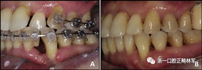 文獻優(yōu)秀正畸病例賞析--多顆牙齒缺失的牙周炎患者的跨學(xué)科綜合治療 文獻優(yōu)秀正畸病例賞析--多顆牙齒缺失的牙周炎患者的跨學(xué)科綜合治療