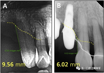 文獻優(yōu)秀正畸病例賞析--多顆牙齒缺失的牙周炎患者的跨學(xué)科綜合治療 文獻優(yōu)秀正畸病例賞析--多顆牙齒缺失的牙周炎患者的跨學(xué)科綜合治療