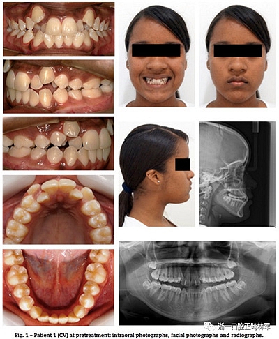 文獻優(yōu)秀正畸病例賞析--同卵雙胞胎使用自鎖托槽和傳統(tǒng)托槽正畸治療比較 文獻優(yōu)秀正畸病例賞析--同卵雙胞胎使用自鎖托槽和傳統(tǒng)托槽正畸治療比較