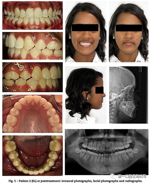 文獻優(yōu)秀正畸病例賞析--同卵雙胞胎使用自鎖托槽和傳統(tǒng)托槽正畸治療比較 文獻優(yōu)秀正畸病例賞析--同卵雙胞胎使用自鎖托槽和傳統(tǒng)托槽正畸治療比較