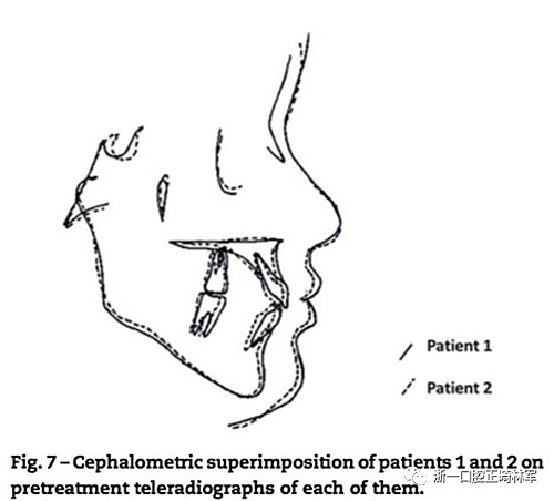 文獻優(yōu)秀正畸病例賞析--同卵雙胞胎使用自鎖托槽和傳統(tǒng)托槽正畸治療比較 文獻優(yōu)秀正畸病例賞析--同卵雙胞胎使用自鎖托槽和傳統(tǒng)托槽正畸治療比較