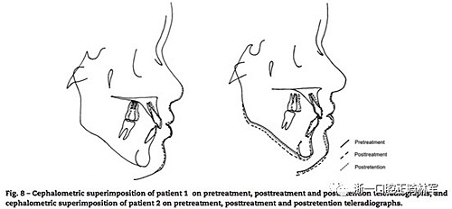 文獻優(yōu)秀正畸病例賞析--同卵雙胞胎使用自鎖托槽和傳統(tǒng)托槽正畸治療比較 文獻優(yōu)秀正畸病例賞析--同卵雙胞胎使用自鎖托槽和傳統(tǒng)托槽正畸治療比較
