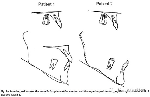 文獻優(yōu)秀正畸病例賞析--同卵雙胞胎使用自鎖托槽和傳統(tǒng)托槽正畸治療比較 文獻優(yōu)秀正畸病例賞析--同卵雙胞胎使用自鎖托槽和傳統(tǒng)托槽正畸治療比較