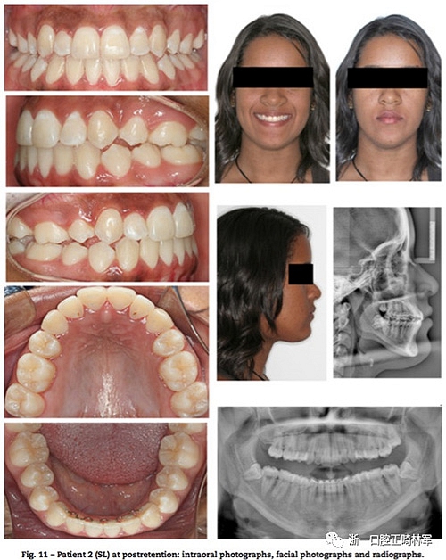 文獻優(yōu)秀正畸病例賞析--同卵雙胞胎使用自鎖托槽和傳統(tǒng)托槽正畸治療比較 文獻優(yōu)秀正畸病例賞析--同卵雙胞胎使用自鎖托槽和傳統(tǒng)托槽正畸治療比較