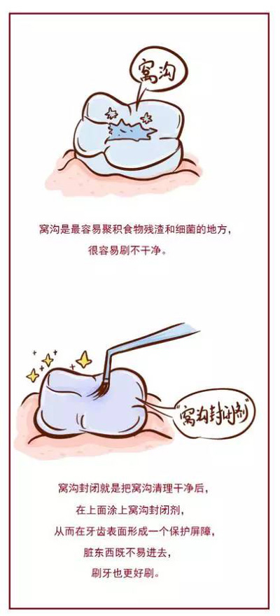 窩溝封閉丨孩子牙齒的&ldquo;鎧甲勇士&rdquo;