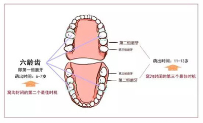 窩溝封閉丨孩子牙齒的&ldquo;鎧甲勇士&rdquo;